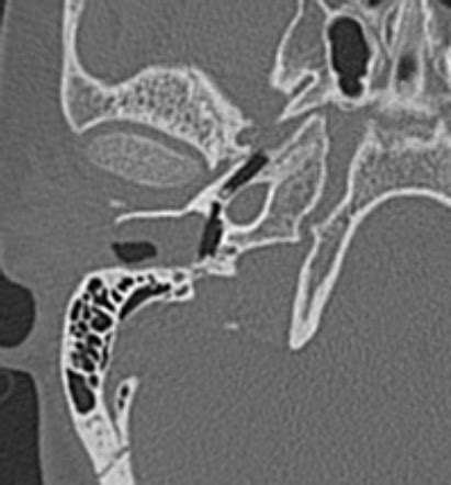 External Auditory Canal Cholesteatoma Image Radiopaedia Org