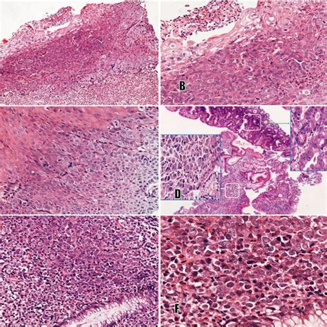 Multiple Primary Tumors A B C Squamous Dysplasia With A Moderate