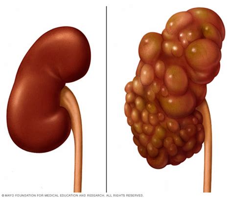 Quistes En Los RiÑonesenfermedad Renal Poliquistica