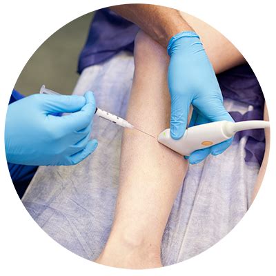 Eliminar Varices Con Escleroterapia Con Espuma Dermitek