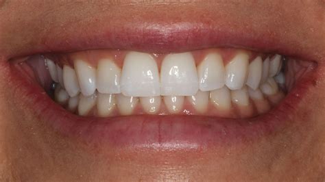 Invisalign 10 Tips To Get The Best Results