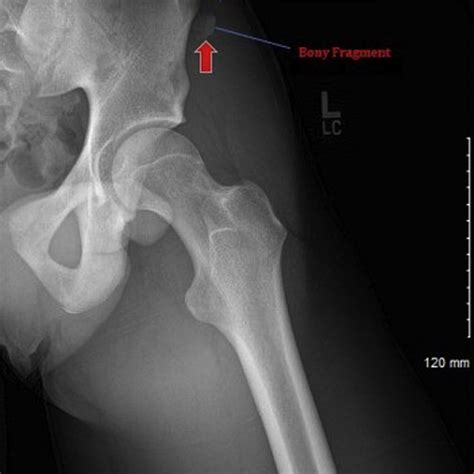 (PDF) ASIS Avulsion Fracture Repair with Lag Screw and Tape Bridge ...