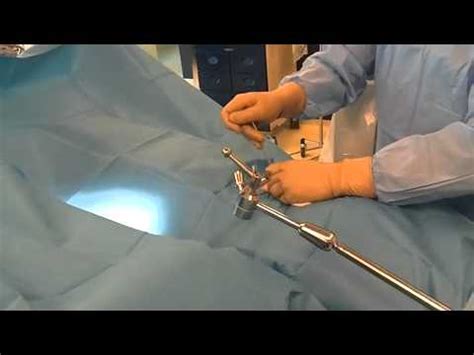 Micro Endoscopic METRx Spine Surgery In Croatia Part 3 YouTube