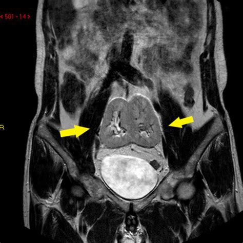 Mri Tse T 1 Weighted Pelvic Location Of Pancake Kidney In Axial View