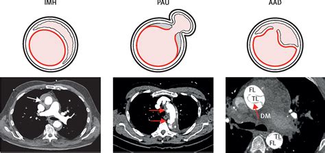 Acute Aortic Dissection The Lancet