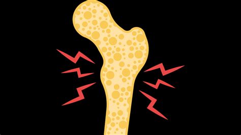 The 1 Complete Guide To Osteoporosis And How It Can Be Prevented