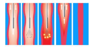 Varicose Veins Treatment In Phoenix Az Laser Vascular Center