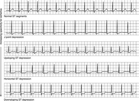 Ischemia And Infarction Ecg In 10 Days 2e Accesscardiology