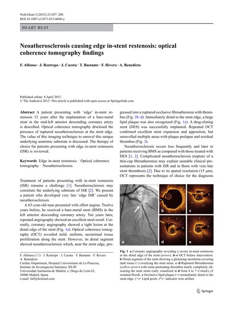 Pdf Neoatherosclerosis Causing Edge In Stent Restenosis Optical