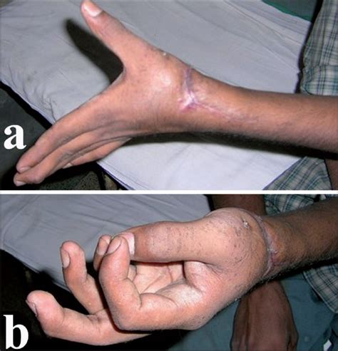 Outcome Of Early Active Mobilization After Extensor Tendon Repair