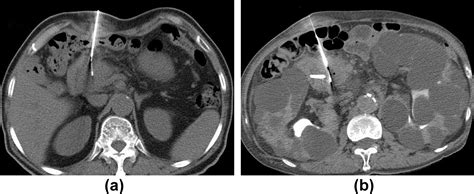 Ct Guided Percutaneous Core Needle Biopsy Of Pancreatic Masses