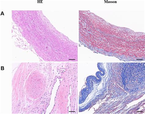 Presence Of Vascular Remodeling In The Pulmonary Endarterectomy Pea