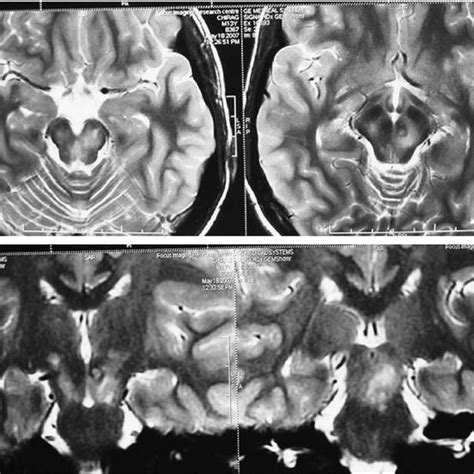 Mri Brain Showing T Hypointense And T Flair Hyperintense Lesions In