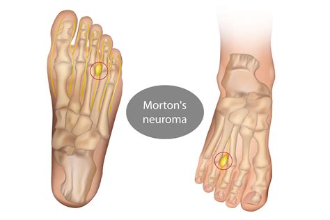 Neuroma Di Morton Orthosurgery