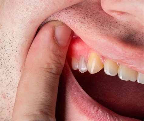 Eliminare il tartaro dai denti a casa perchè non farlo