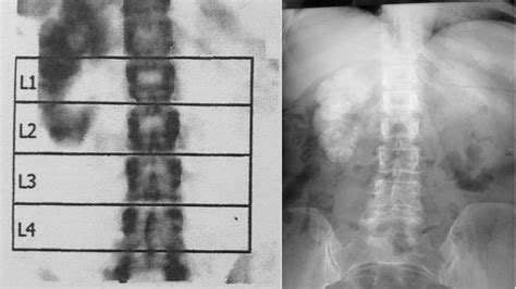 Dual Energy X Ray Absorptiometry In The Diagnosis Of Osteoporosis A