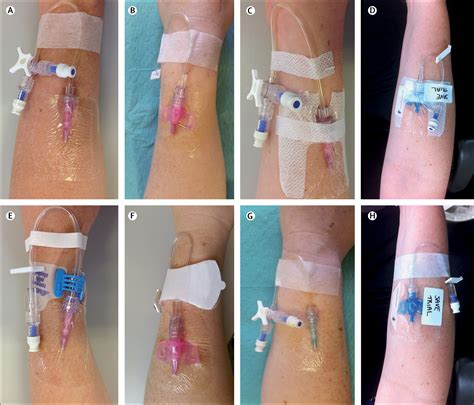 Intravenous Catheter