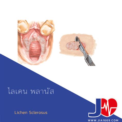 Lichen Sclerosus Jia