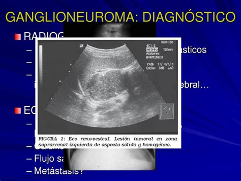 Ppt Ganglioneuroma Y Otros Tumores Retroperitoneales Primarios A