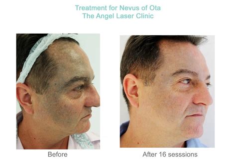 Nevus Of Ota Treatment In London The Angel Laser Clinic