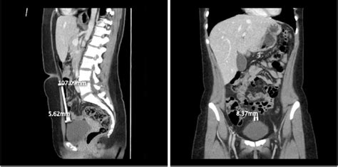 Venous Phase CT Scan Tubular Structure Of Approximately 11 Cm Long