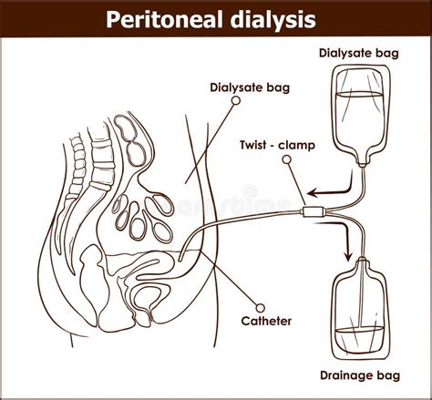 Dialyse Péritonéale Illustration De Vecteur Illustration Du Espace