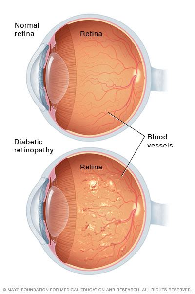 Diabetic Retinopathy Mayo Clinic