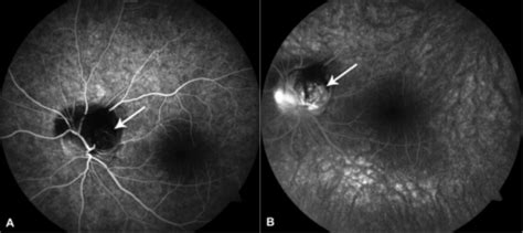 Optic Disk Melanocytoma And Optical Coherence Tomography Angiography Oct A Eyewiki