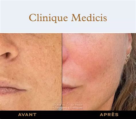 PRX T33 Light Peel Paris Dr Abbou And Dr Pessis Plastic Surgeons