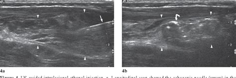 Figure 1 From Real Time Ultrasound Guided Ethanol Sclerotherapy Of A