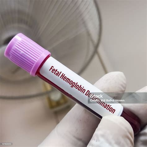 Blood Sample For Fetal Hemoglobin Determination Test To Diagnosis Of