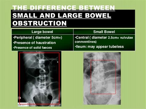 Diagnosis And Managment Of Intestinal Obstruction By Dr Moh Hazem El…