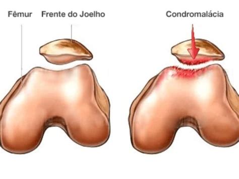 Condromalacia Patelar Exercicios Contra Indicados Braincp