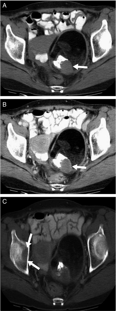 CT Findings Of Mature Cystic Teratoma With Malignant Transformation