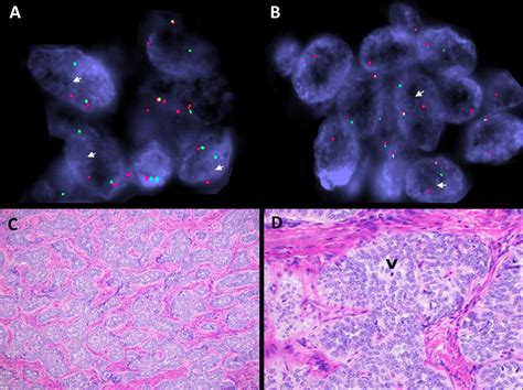 Uterine Tumor Resembling Ovarian Sex Cord Tumor Utrosct A