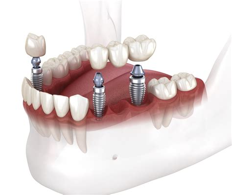 Tooth Extraction And Dental Implants Santa Rosa Ca