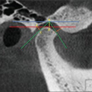 Prevalence Of TMD Disorders For All Participants By Sex And Side