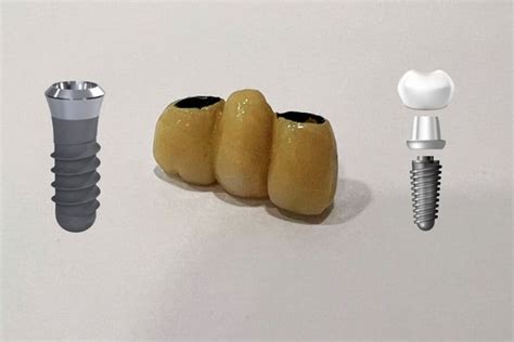 Noticia Implantes Dentales Vs Puentes Cu L Es La Mejor Opci N