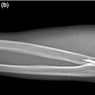 A Anteroposterior X Ray Of A 44 Year Old Male Patient Undergoing