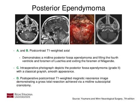 Ependymoma