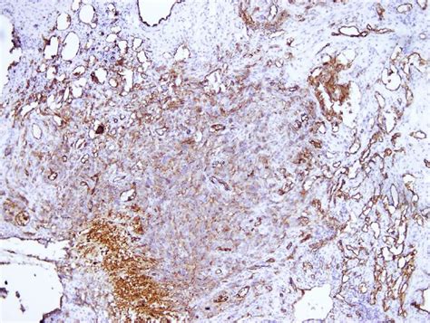 Cd31 Immunohistochemical Staining Of Ovarian Angiosarcoma Download