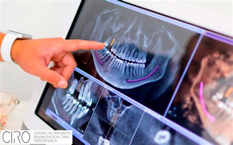 Ltima Tecnolog A En Implantes Dentales En Cl Nica Ciro