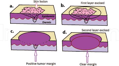 Figure 3 From Mohs Micrographic Surgery Semantic Scholar