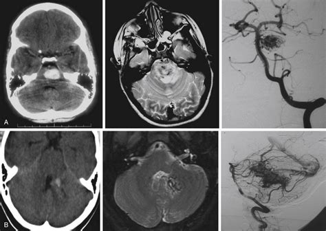 Surgical Management Of Infratentorial Arteriovenous Malformations Neupsy Key