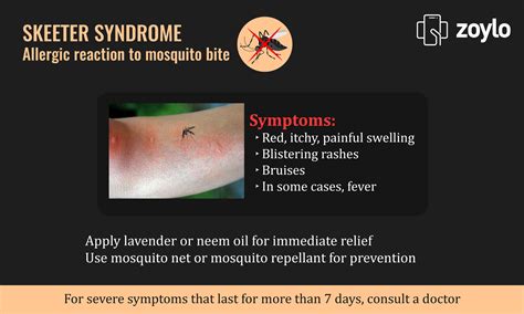 Skeeter Syndrome Allergic Reaction To Mosquito Bite Health Tips