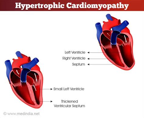 Hypertrophic Cardiomyopathy Causes Symptoms Diagnosis Treatment