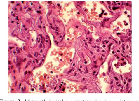 Figure From Cavernous Hemangioma Of The Left Atrial Appendage