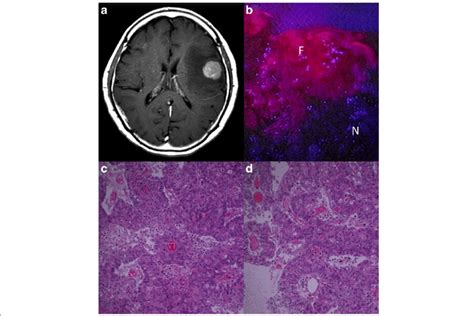 Representative Metastatic Tumor With Strong Ppix Fluorescence Case 5