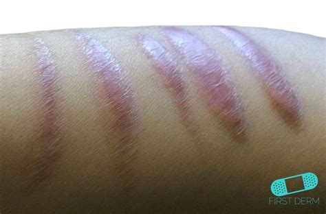 Online Dermatology Keloid Hypertrophic Scar