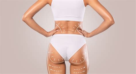 What Influences The Price Of A Brazilian Butt Lift Surgery